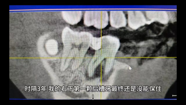 牙科确实暴利,医生看病全凭良心!时隔3年我的后槽牙还是没保住