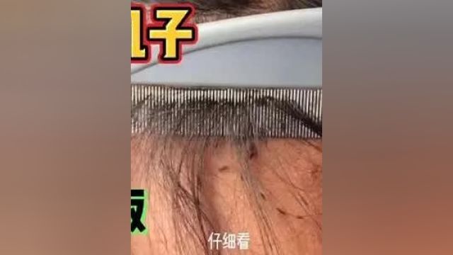 看着让人头皮发麻的虱子,你有长过吗? 虱子 解压 强迫症治愈系