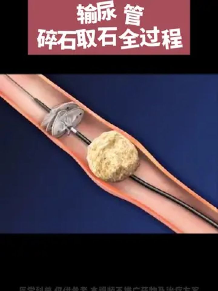 输尿管 碎石取石全过程 #男人 #泌尿 #结石