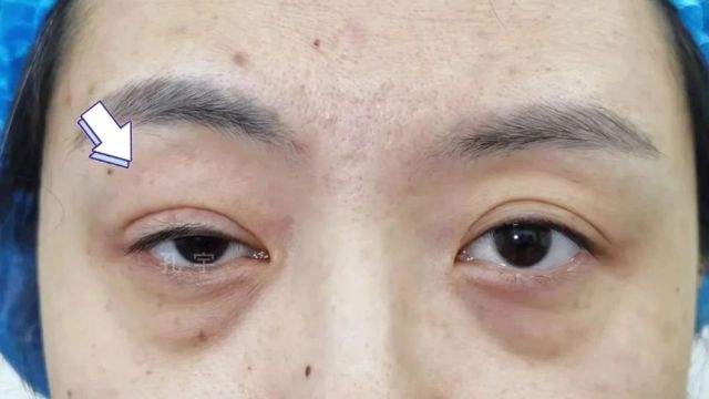 【孔宇:2年半前做的右眼重度上睑下垂修复】