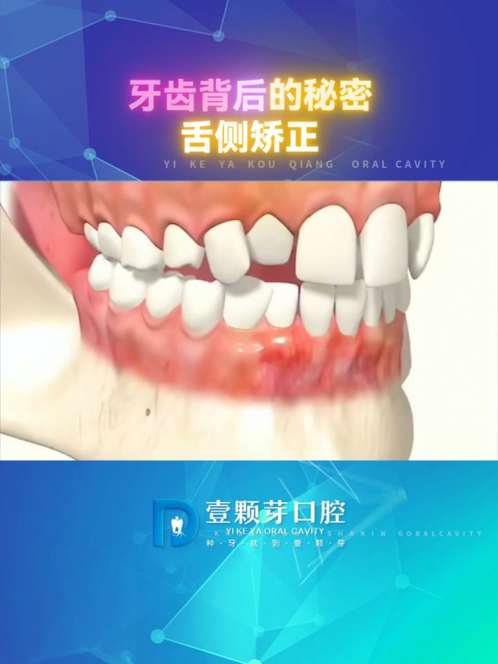 明8215同款舌侧矫正78牙套中的"爱马仕","只见变化不见牙套"