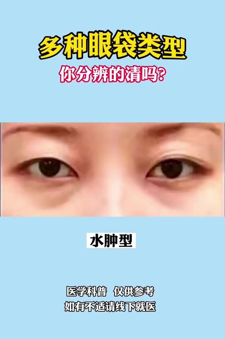 一般多大年龄就有眼袋了百科在线
