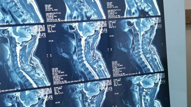 颈椎椎管狭窄,脊髓影像学受压,是否预防减压手术?#医学科普