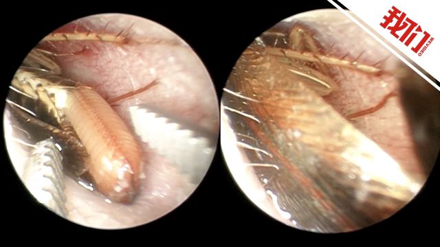 男子睡觉时一只产卵蟑螂钻进耳道 医生麻醉蟑螂后完整取出