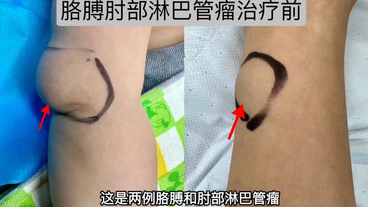 小孩胳膊肘肿鼓包大疙瘩多考虑淋巴管瘤