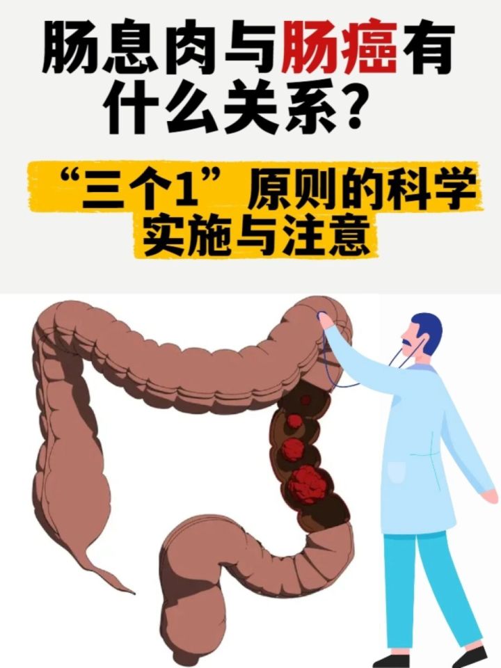 肠息肉与肠癌有什么关系？“三个1”原则的科学实施与注意说起肠癌，很多人觉得离自己还远，可生活中有不少中老年人已经被这事儿搅..._高清