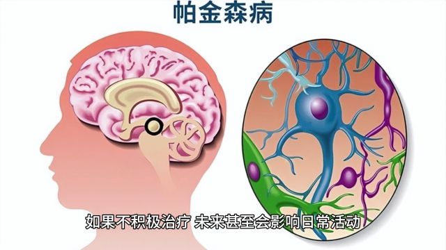 帕金森病:抖动从哪里开始?了解症状是关键!