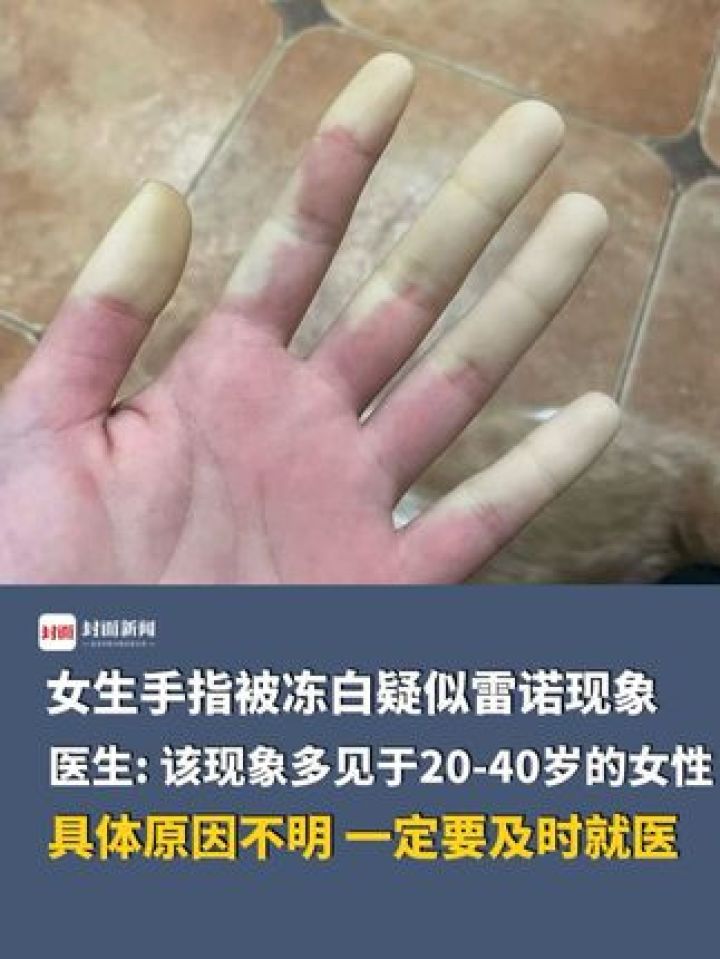 女生手指被冻白疑似#雷诺现象,医生:该现象多见于20-40岁的女性,具体