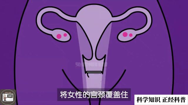 98的人可能都不知道有女用的避孕套:避孕海绵,它是什么,怎么用?