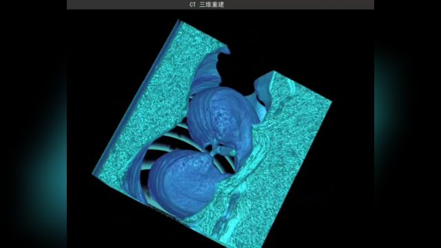 CT三维重建,Python PyQt 医学图像 趣味重建 CT肺部三维重建 VTK