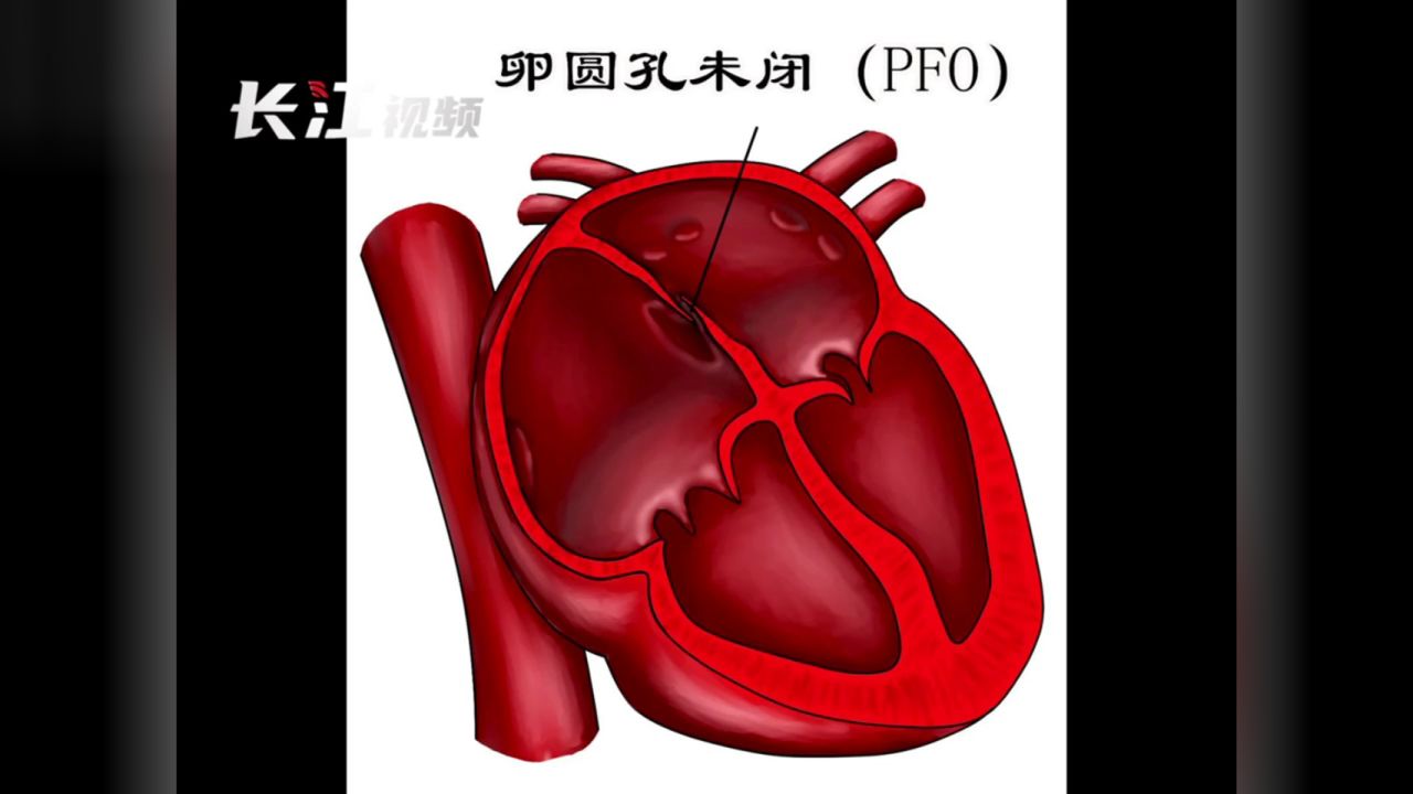 心脏卵圆孔封堵器图片图片