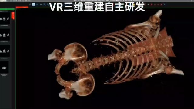 云pacs三维重建vr 通过算法将2d图像转换为3d