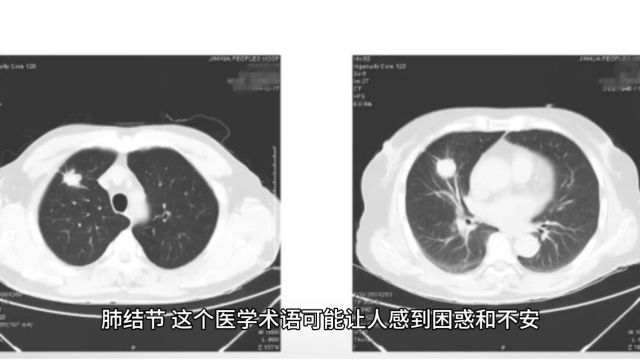 张纾难肺结节的奥秘