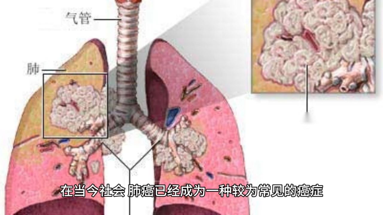 肺癌晚期最怕三个征兆苏惠萍