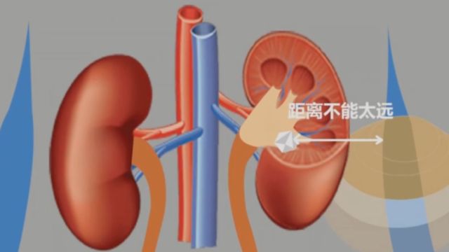 体外冲击波碎石,适合于哪些情况下应用?听郝医生是如何解答的