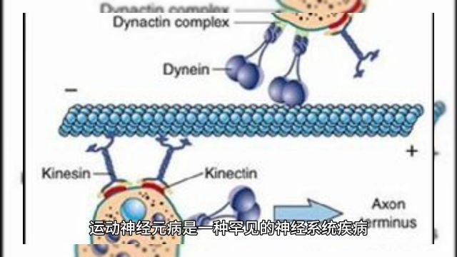 运动神经元病是一种罕见的神经系统疾病,它会破坏大脑和脊髓中控制肌肉运动的神经元,导致肌肉无力、萎缩和僵硬.这种疾病通常会逐渐加重