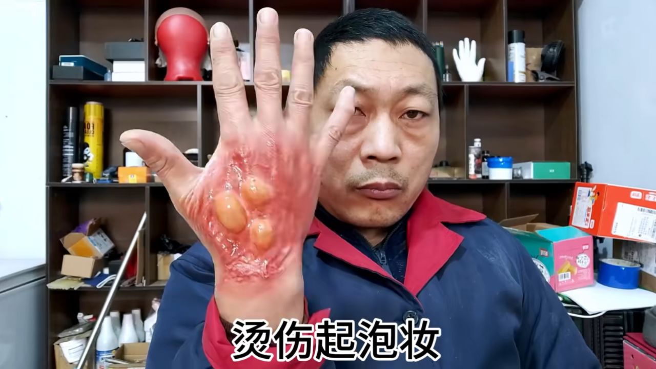 烫伤起泡特效化妆
