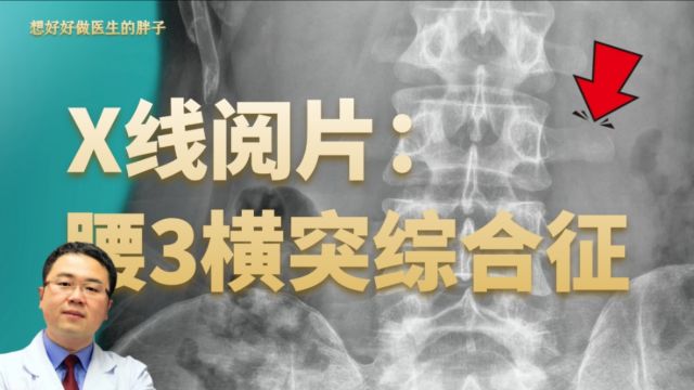 腰痛啊,别只想到腰椎间盘突出!医生带您了解腰3横突综合症