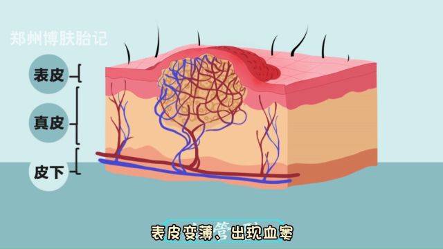 鲜红斑痣如果不及时治疗,病灶可能会随着时间变化而逐渐加深,那么,鲜红斑痣是如何发展的?