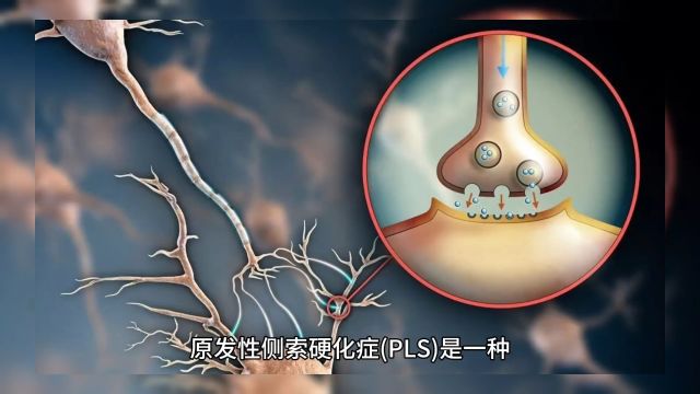 原发性侧索硬化症(PLS):累及上运动神经元.临床呈现缓慢进展的肢体上运动神经元瘫痪、肌无力、肌张力增高、痉挛性步态、腱反射亢进