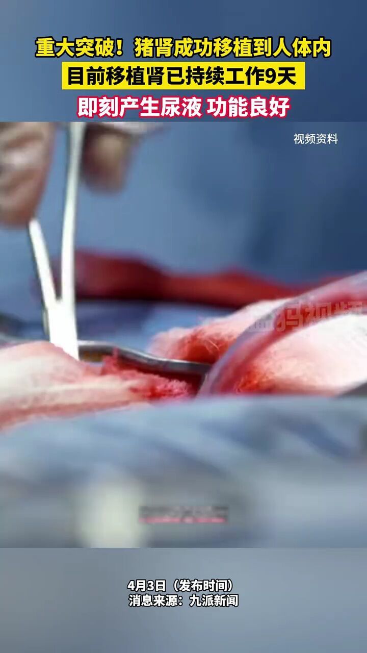 重大突破!我国医生成功将猪肾移植到人体内,目前移植肾已持续工作9天