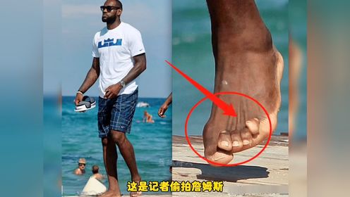 看完这些你还会羡慕nba球员吗?詹姆斯的脚畸形的让人心疼