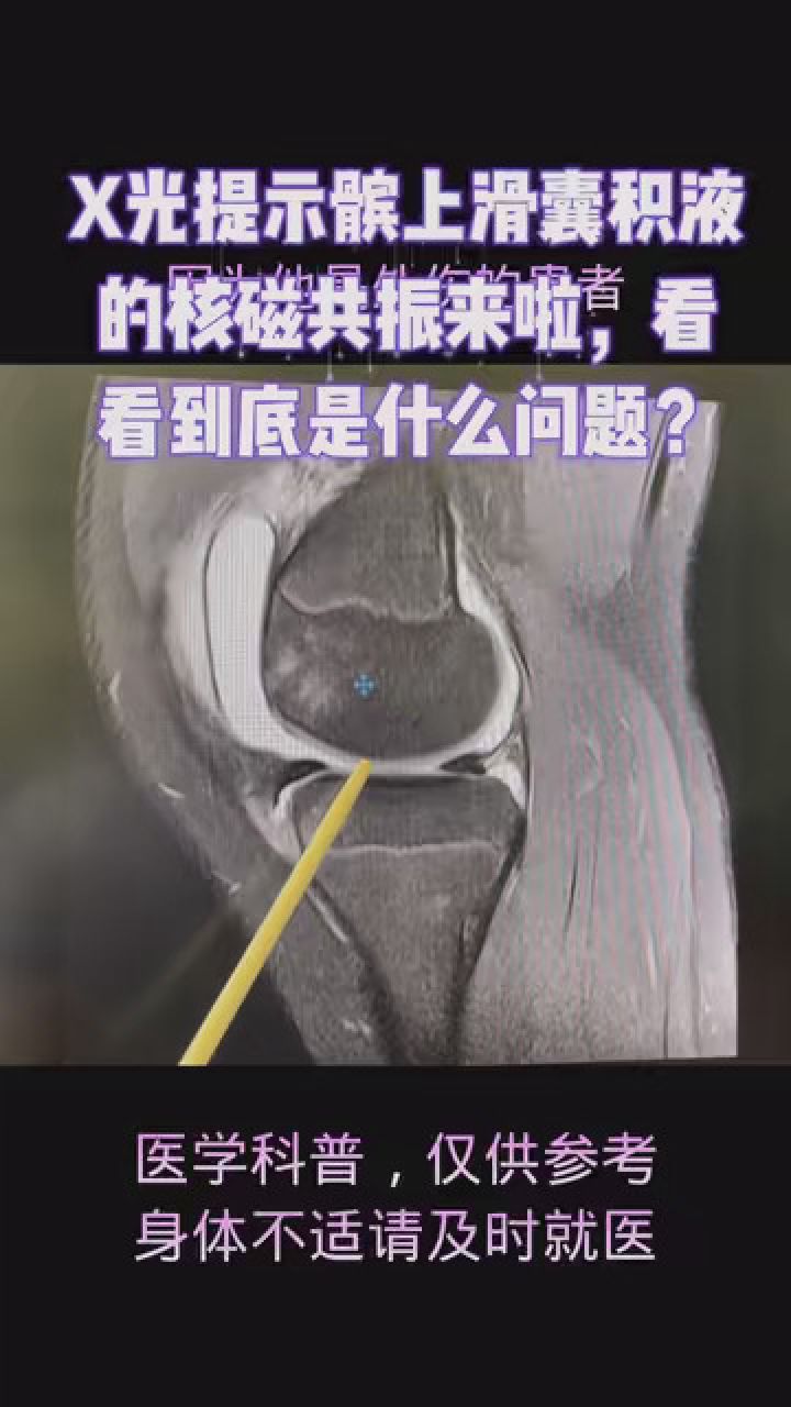 这个病例是膝关节外伤来了拍x光,我看到膝关节腔和髌上滑囊有积液