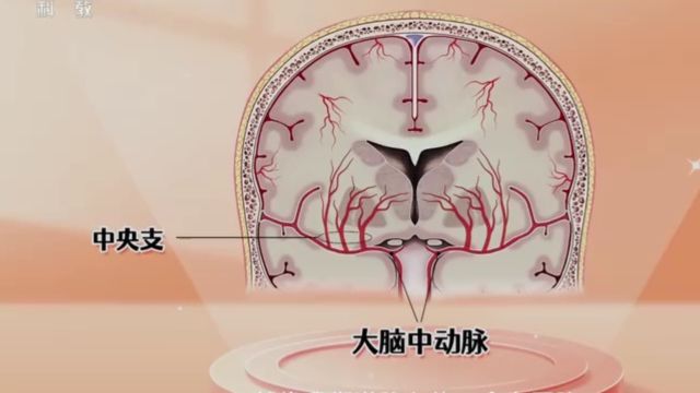 正常的大脑中动脉大概是4毫米,它相当于主干路,在人体很是重要