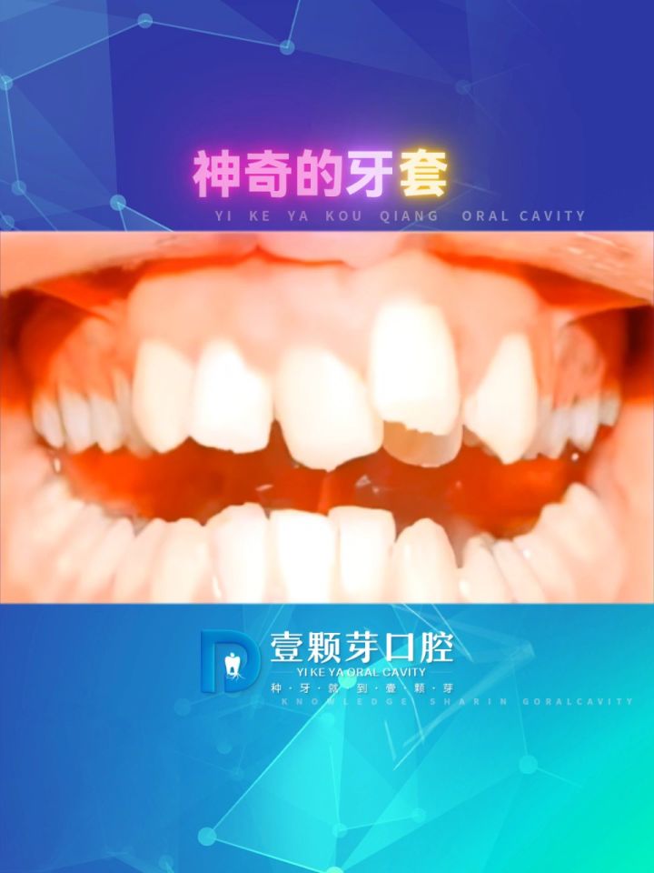牙齿排列错乱,不美观,不易清洁"神奇的牙套"专齿矫正,控根移动,快速