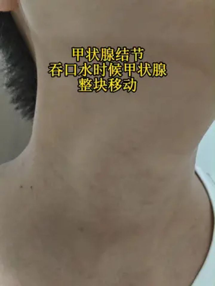 甲状腺肿大 #甲状腺结节 #甲亢 #微创消融 #硬核健康科普行动