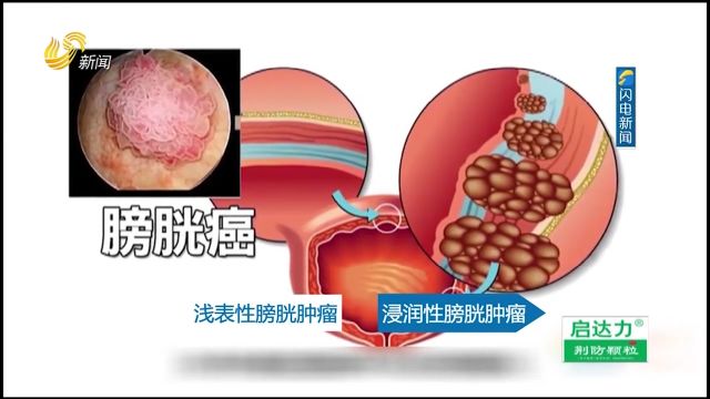 患了膀胱癌别惊慌,不同手术方式进行治疗,专家结合模式图做解释