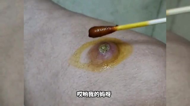 这是啥情况竟然起这么大疙瘩