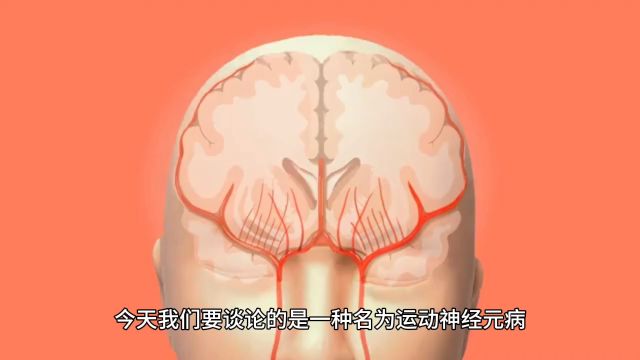 运动神经元病(Motor Neuron DiseaseMND)是以损害脊髓前角,桥延脑颅神经运动核和锥体束为主的一组慢性进行性变