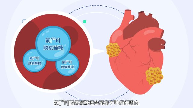 【小核同学科普秀】“核技术”也能守护健康?“核医疗”篇(二)