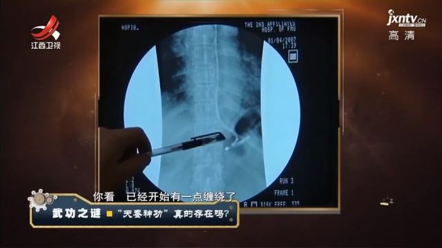 自称练了天蚕决,男子能用鼻子穿绳提水,竟是把绳吸进了胃里