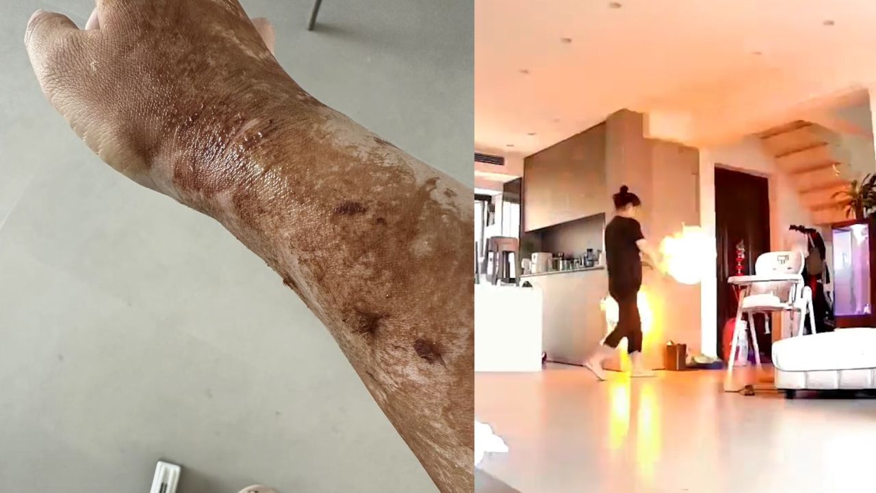 女子抠破氢气球爆炸灼伤胳膊吓傻,以为漏气了没危险:不要给娃买