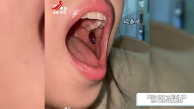 女生口腔内长了个巨大血泡,随后紧急用针头将其戳破