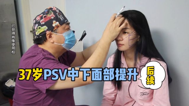 李晓东案例分享:37岁PSV中下面部提升续集