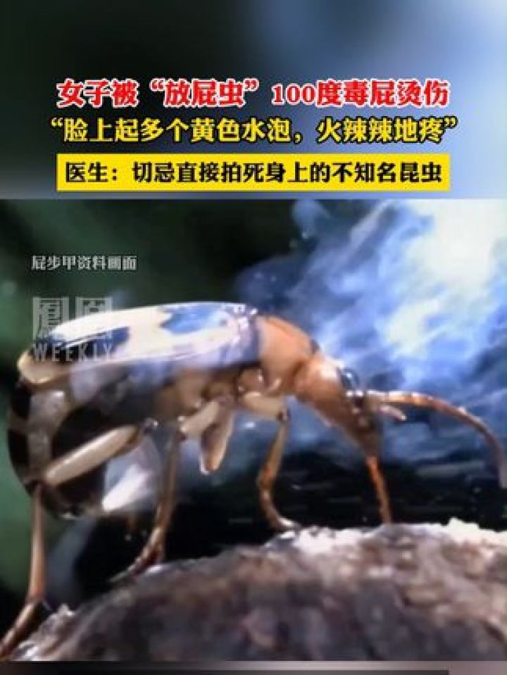 女子被放屁虫100度毒屁烫伤 ,脸上起多个黄白色水泡,医生:切忌直接拍