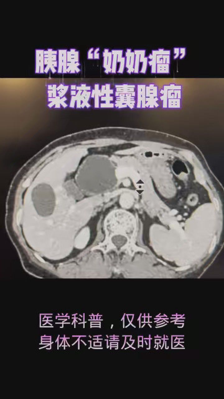 胰腺囊腺癌图片