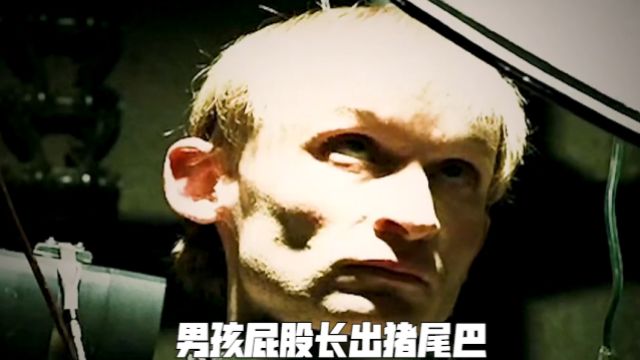 男孩屁股长出猪尾巴,多年后竟长到上千斤,导致生活不能自理