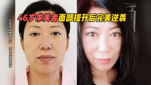 46岁求美者面部提升后完美逆袭李晓东面部提升案例