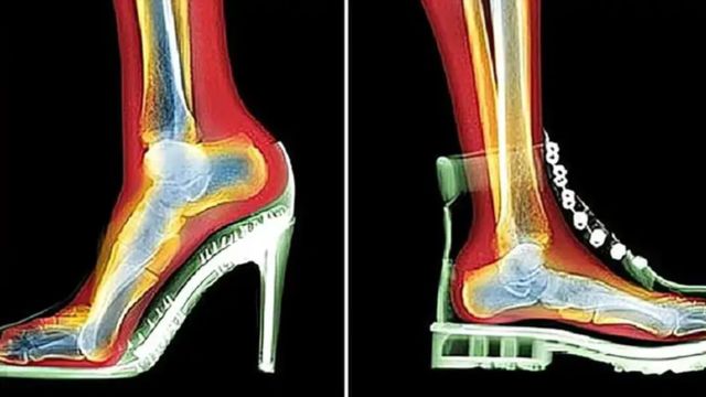 长期穿高跟鞋和平底鞋的女生,20年后有啥不同?看完才知道利害