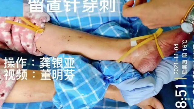 操作视频:留置针 3 大穿刺法,教你学会正确穿刺!