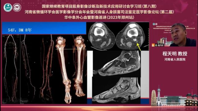 糖尿病足的影像学诊断与鉴别诊断河南省人民医院程天明