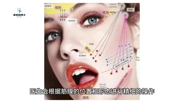 分享篇:筋膜提升是怎么做的?筋膜提拉术手术全过程展示!