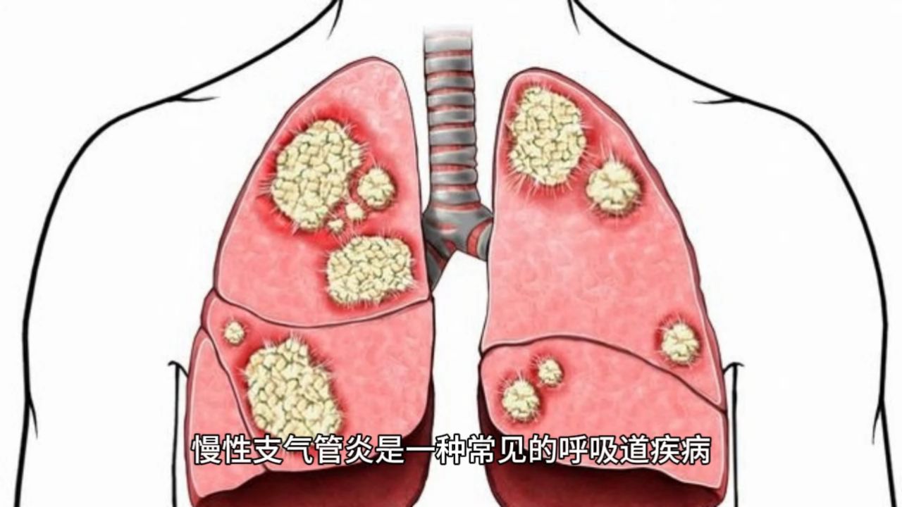 靖旭荔慢性支气管炎的症状表现有哪些