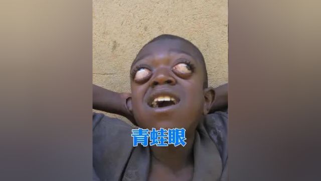 人人羡慕的大眼睛双眼皮,却被人说成青蛙眼