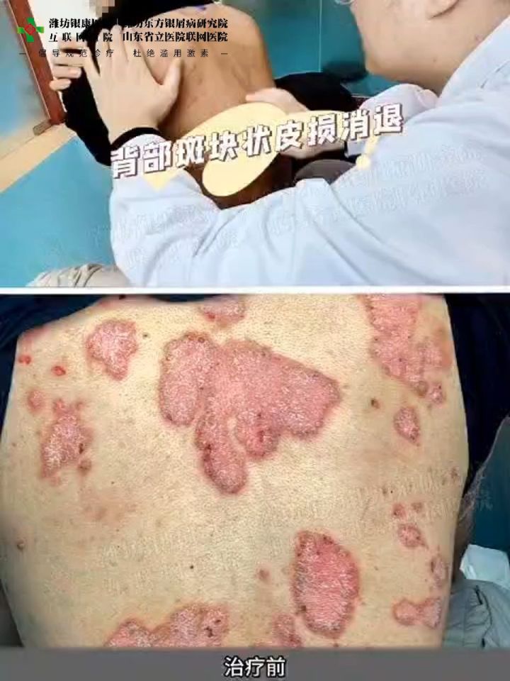 临沂银屑病—潍坊东方皮肤病医院—儿童银屑病的症状表现图片