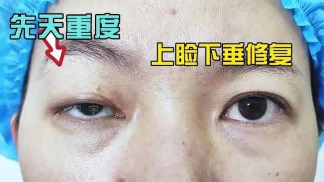 【孔宇:云南姑娘第3次右眼重度上睑下垂矫正(CFS)】